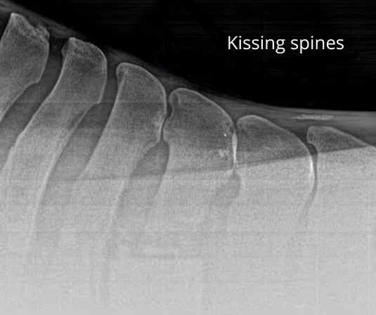Kissing Spine